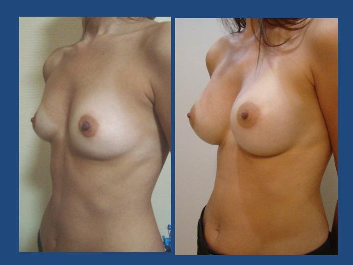 Before and after result by Dr. Ergin Er