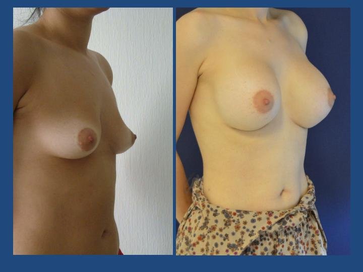 Before and after result by Dr. Ergin Er