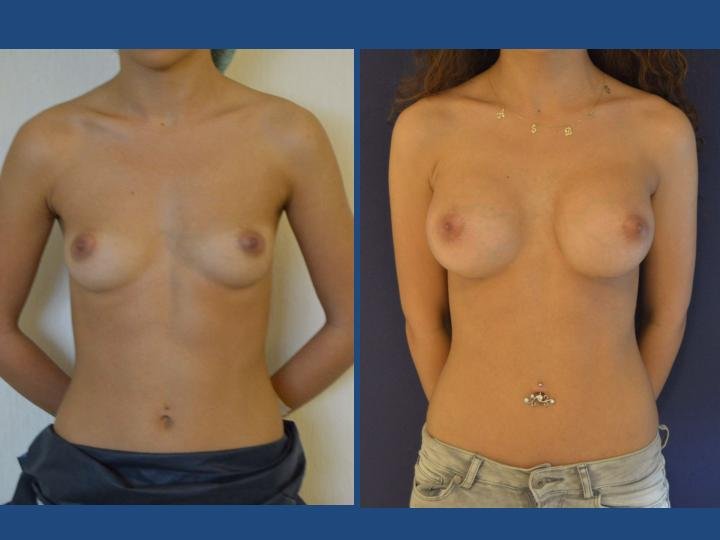 Before and after result by Dr. Ergin Er