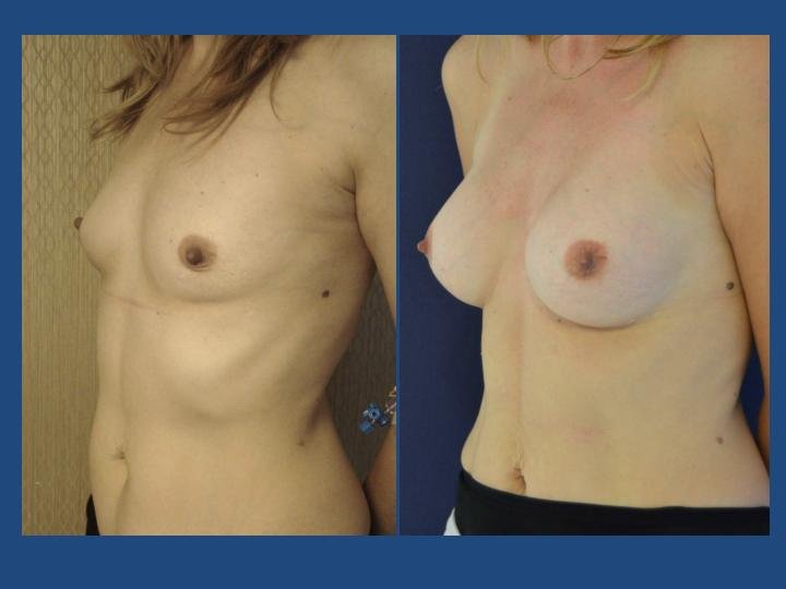 Before and after result by Dr. Ergin Er