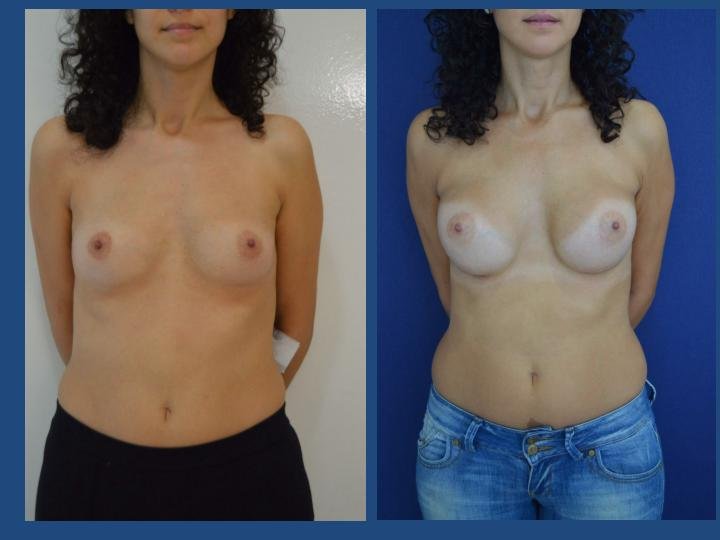 Before and after result by Dr. Ergin Er