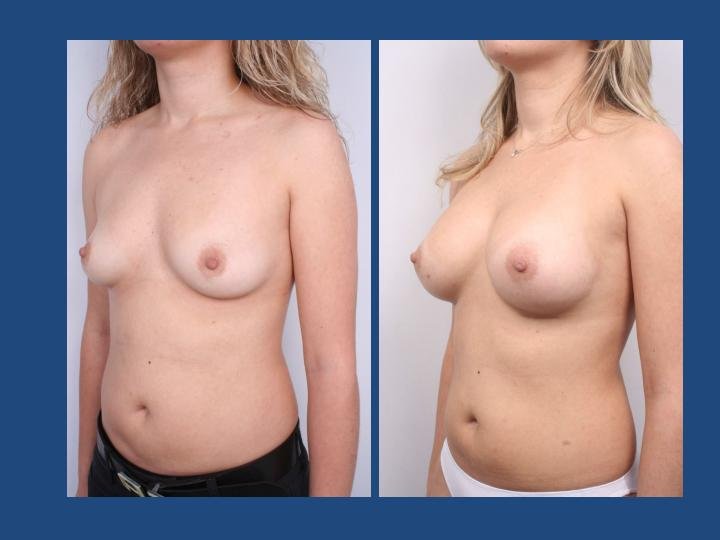Before and after result by Dr. Ergin Er