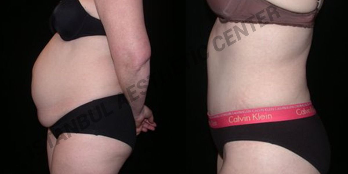 Before and after result by Dr. Ergin Er