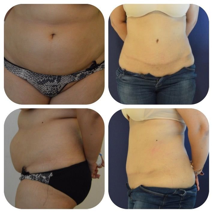 Before and after result by Dr. Ergin Er
