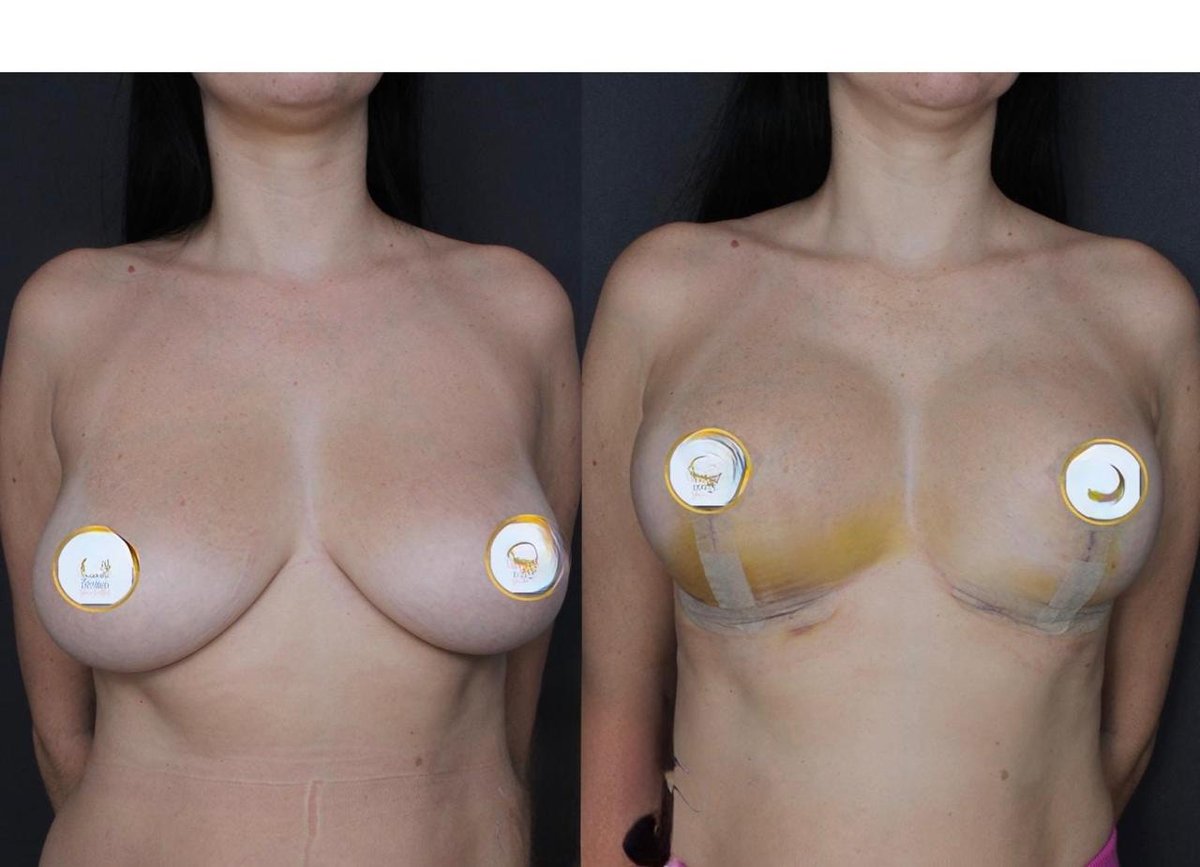Before and after result by Dr. Ergin Er