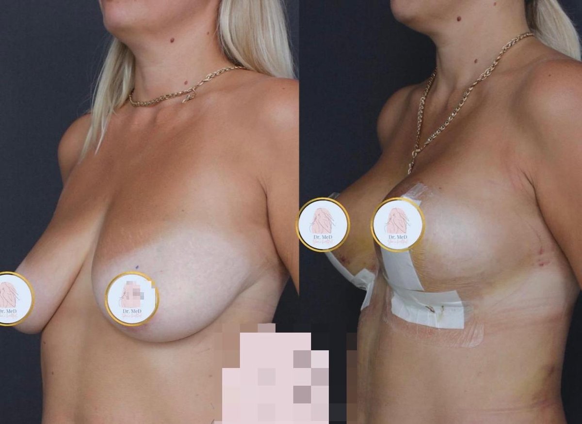 Before and after result by Dr. Ergin Er
