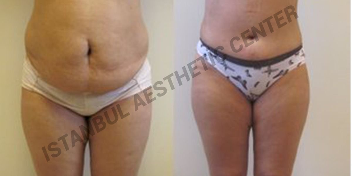 Before and after result by Dr. Ergin Er