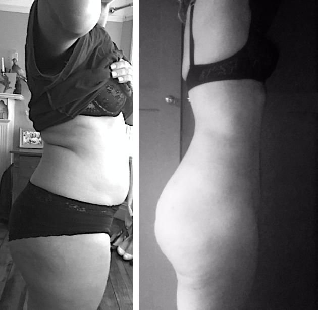 Before and after result by Dr. Ergin Er