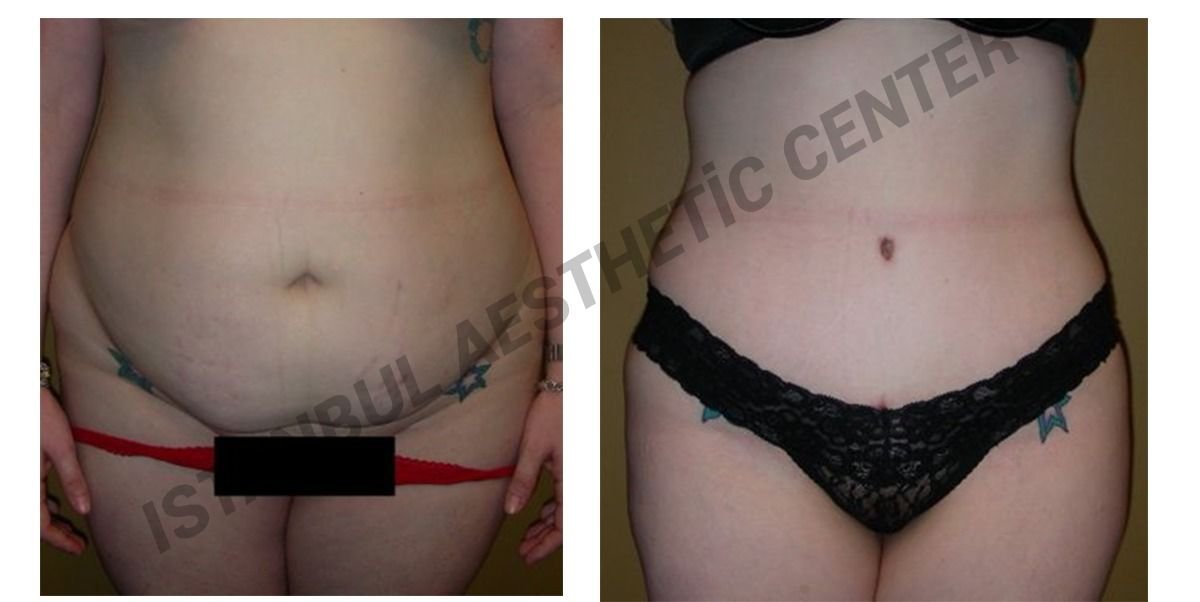 Before and after result by Dr. Ergin Er