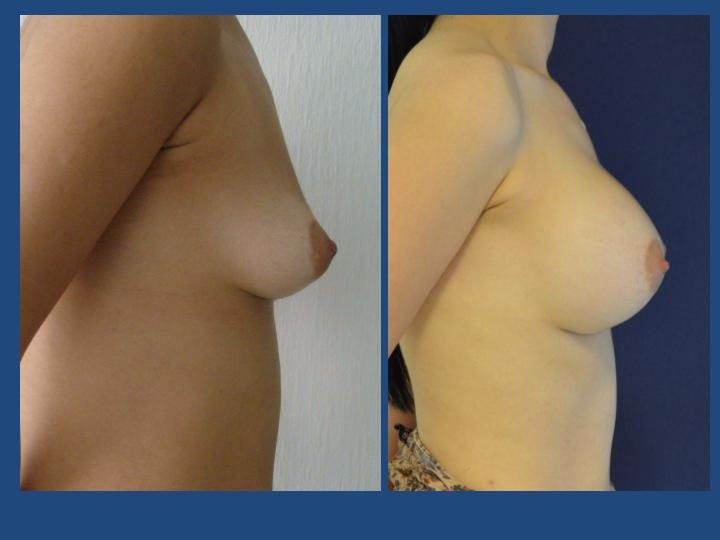 Before and after result by Dr. Ergin Er