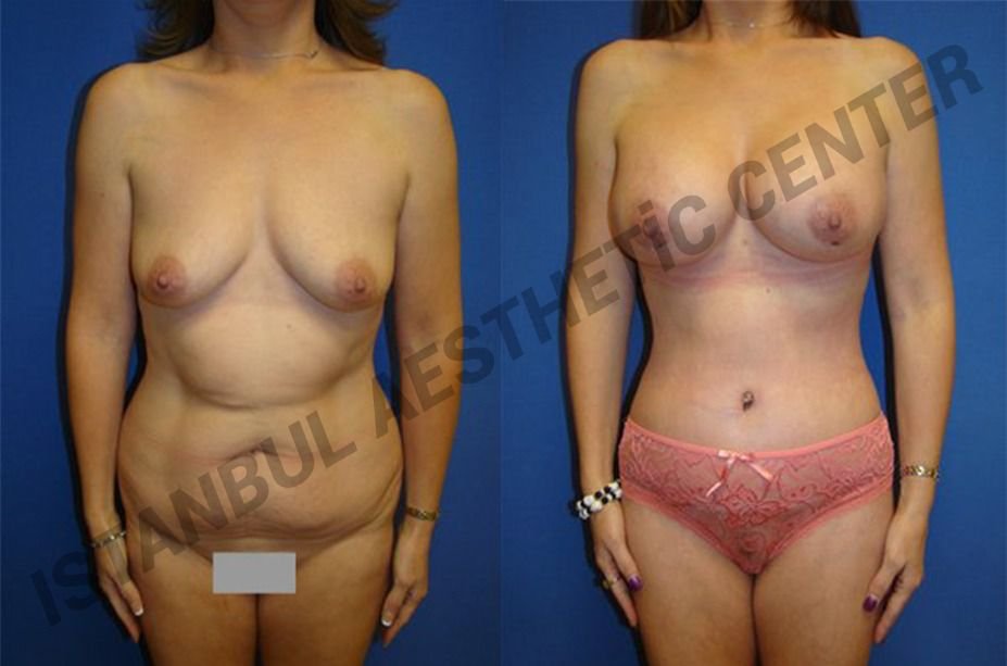 Before and after result by Dr. Ergin Er