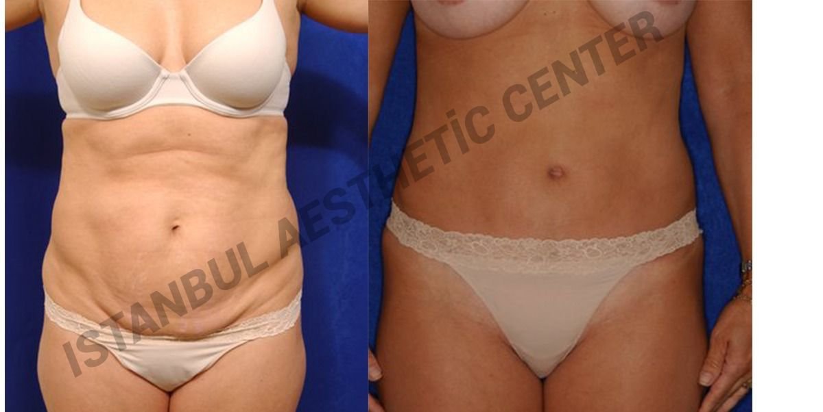 Before and after result by Dr. Ergin Er