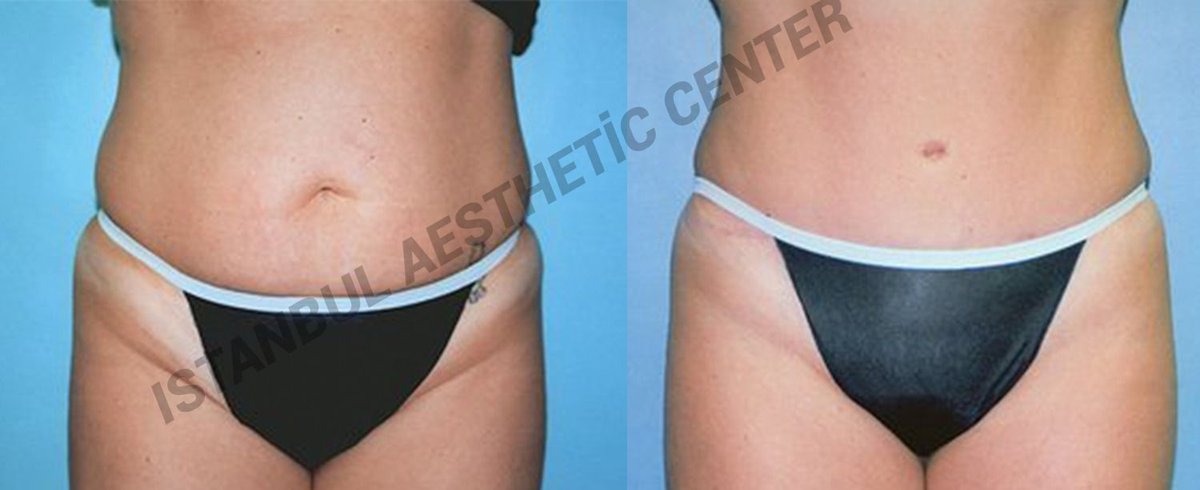 Before and after result by Dr. Ergin Er