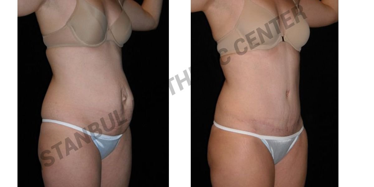 Before and after result by Dr. Ergin Er