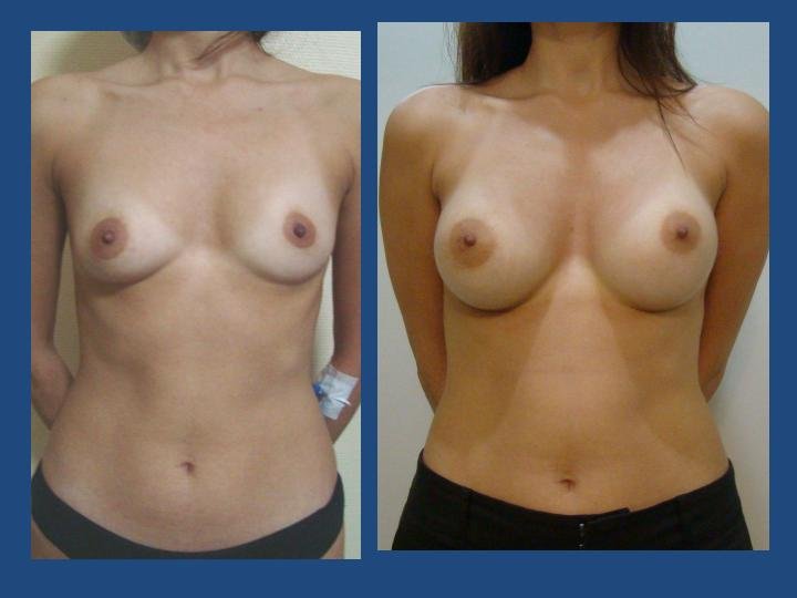Before and after result by Dr. Ergin Er