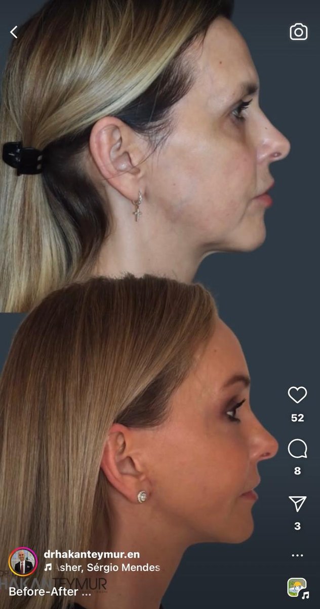 Before and after result
