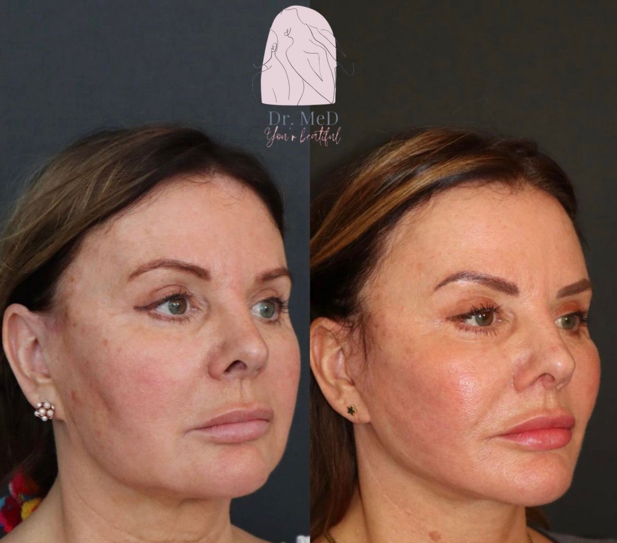 Before and after result by Dr. Hakan Teymur
