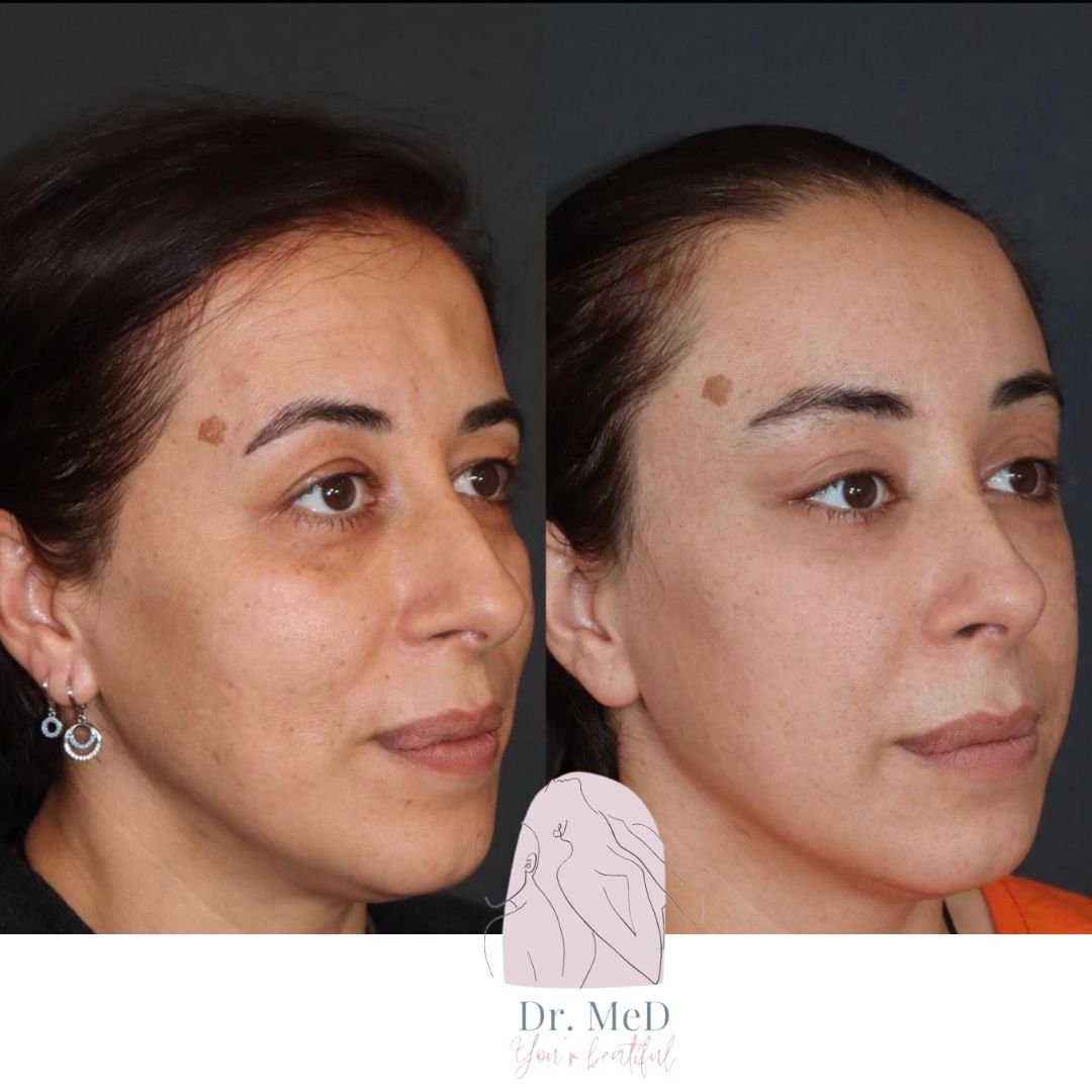 Before and after result by Dr. Hakan Teymur