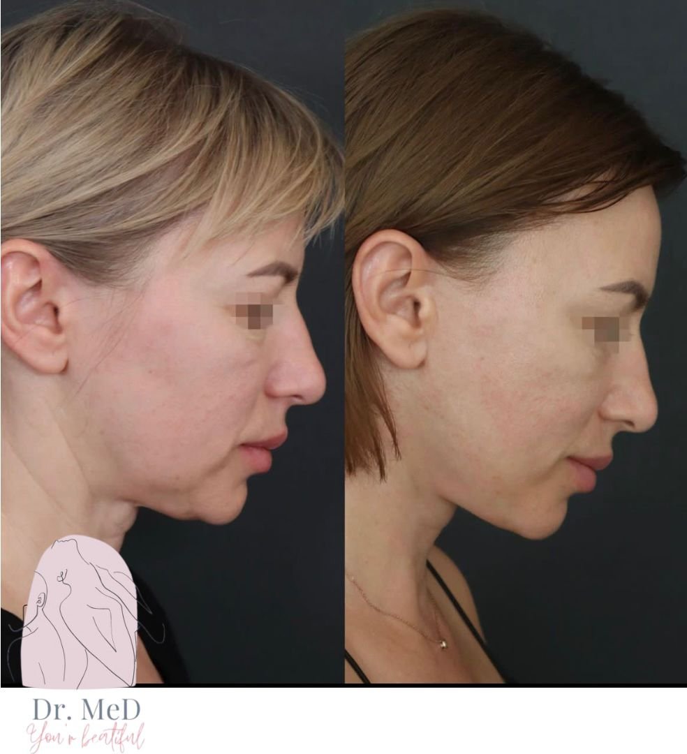 Before and after result by Dr. Hakan Teymur
