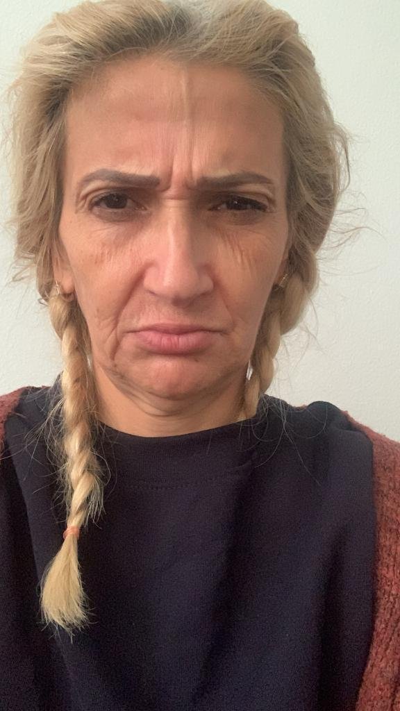Before and after result by Dr. Hakan Teymur