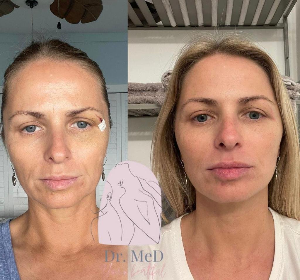 Before and after result by Dr. Hakan Teymur