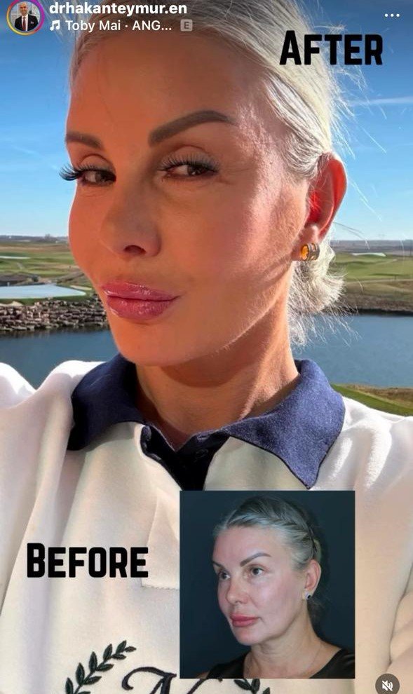Before and after result
