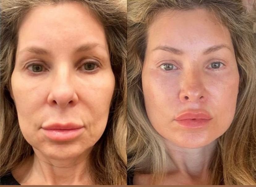 Before and after result by Dr. Hakan Teymur