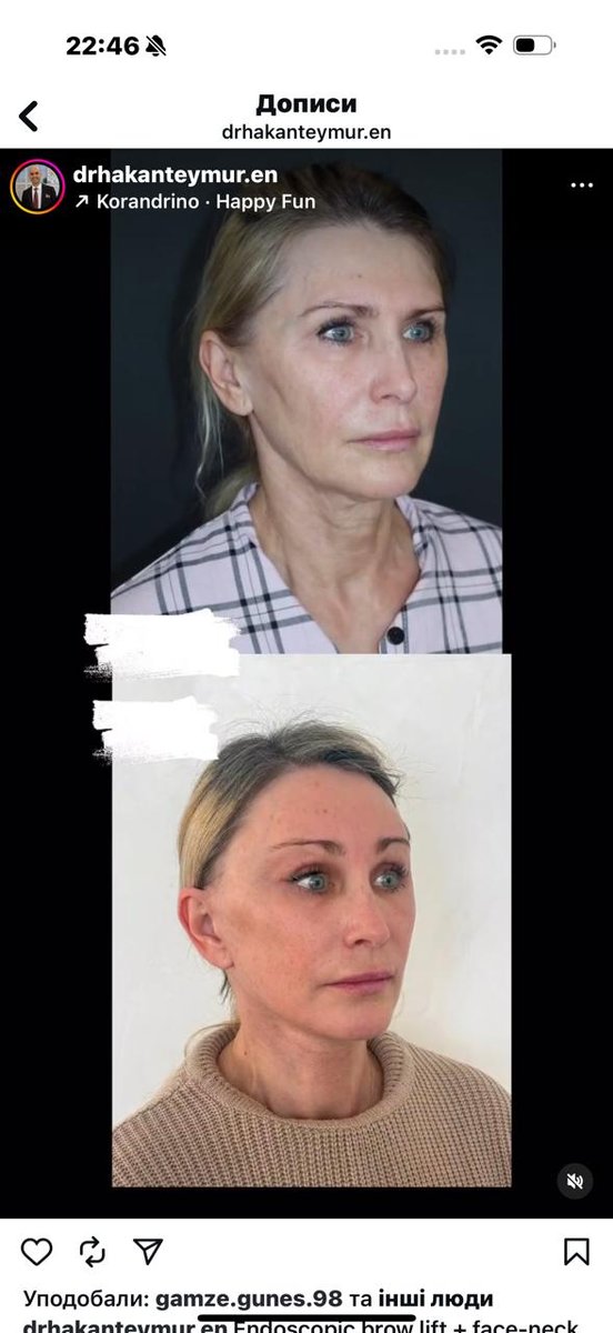 Before and after result by Dr. Hakan Teymur