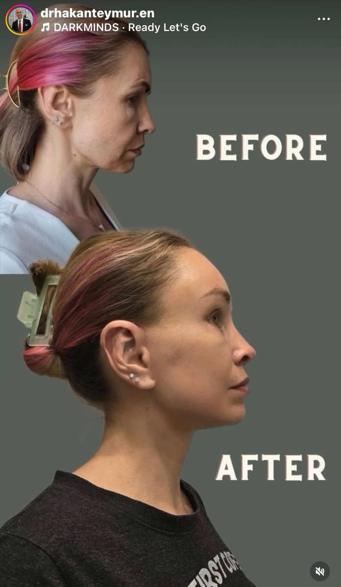 Before and after result
