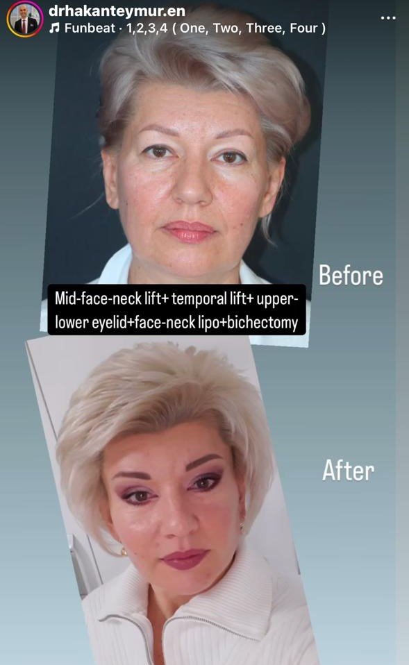 Before and after result by Dr. Hakan Teymur