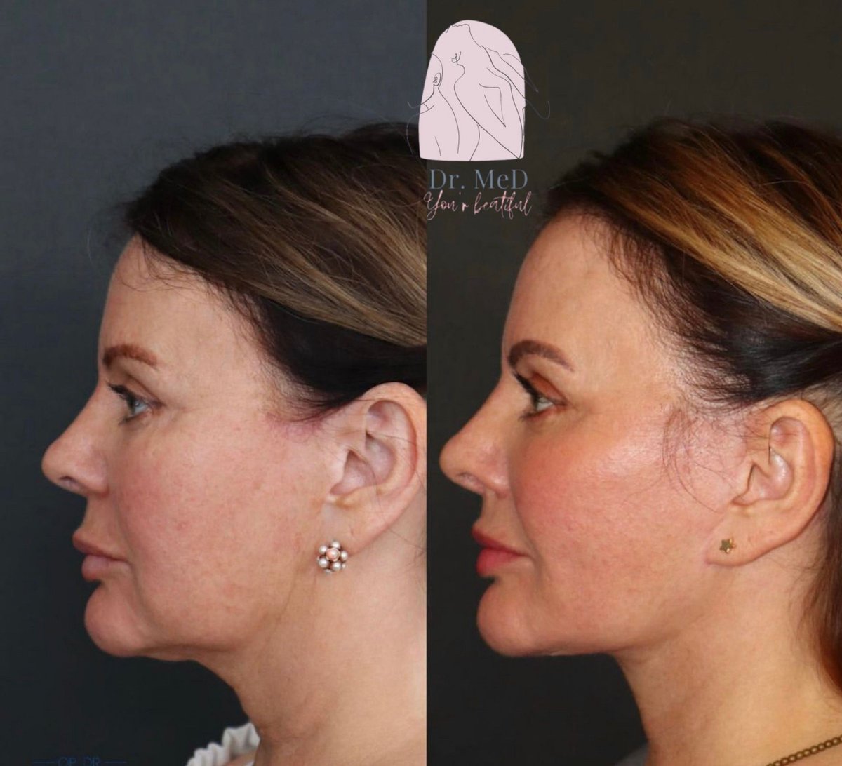 Before and after result by Dr. Hakan Teymur