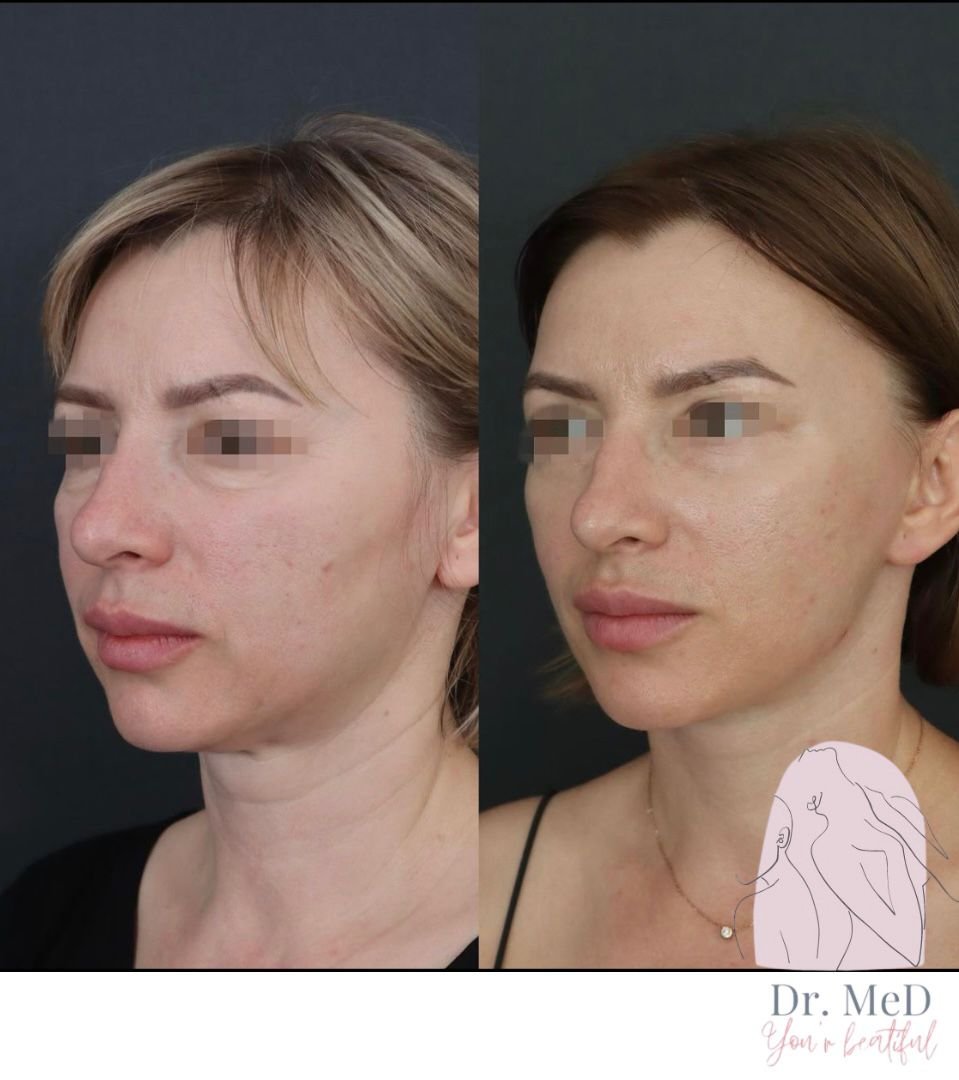 Before and after result by Dr. Hakan Teymur