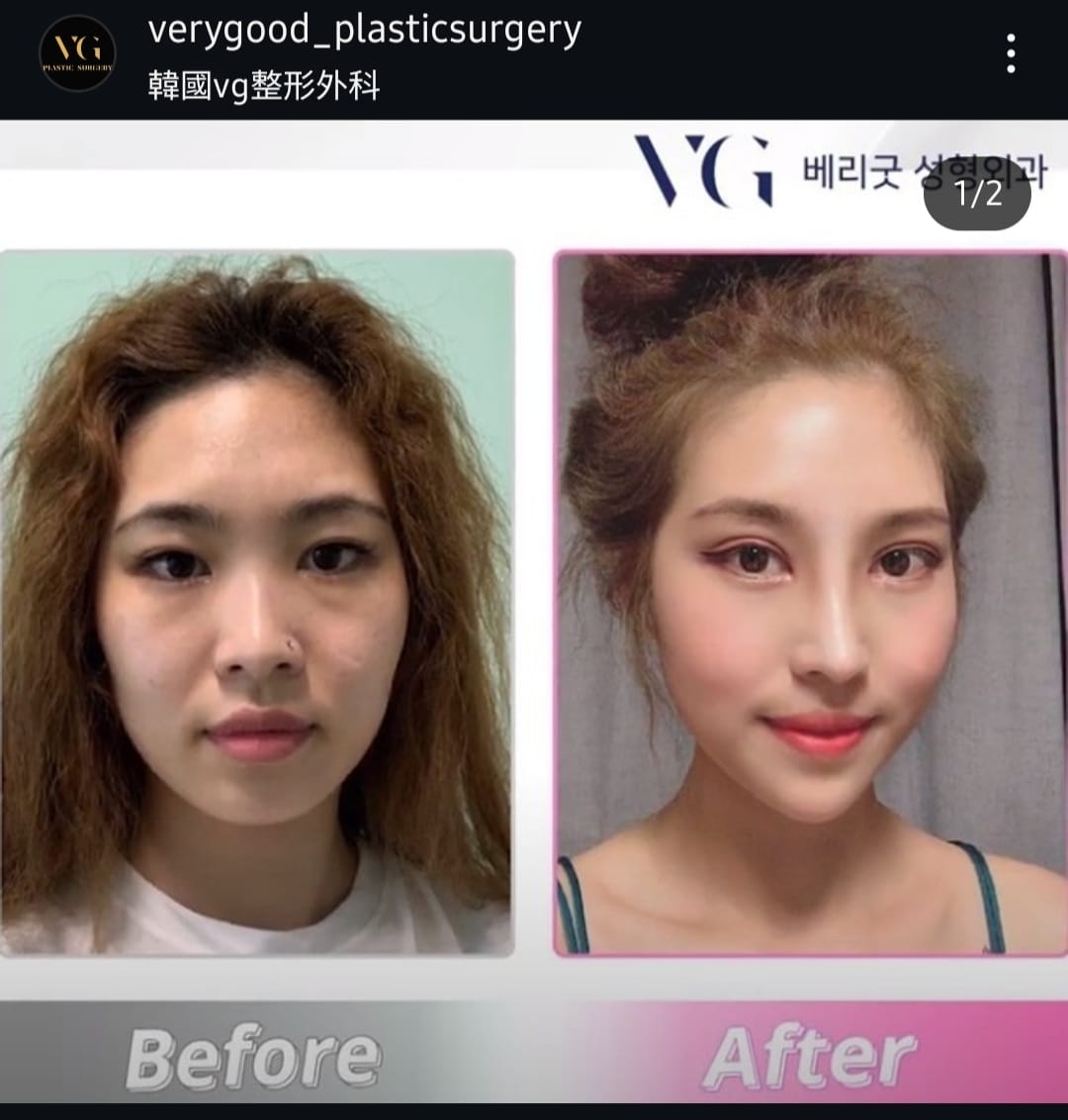 Before and after result by Dr. Im Young Min