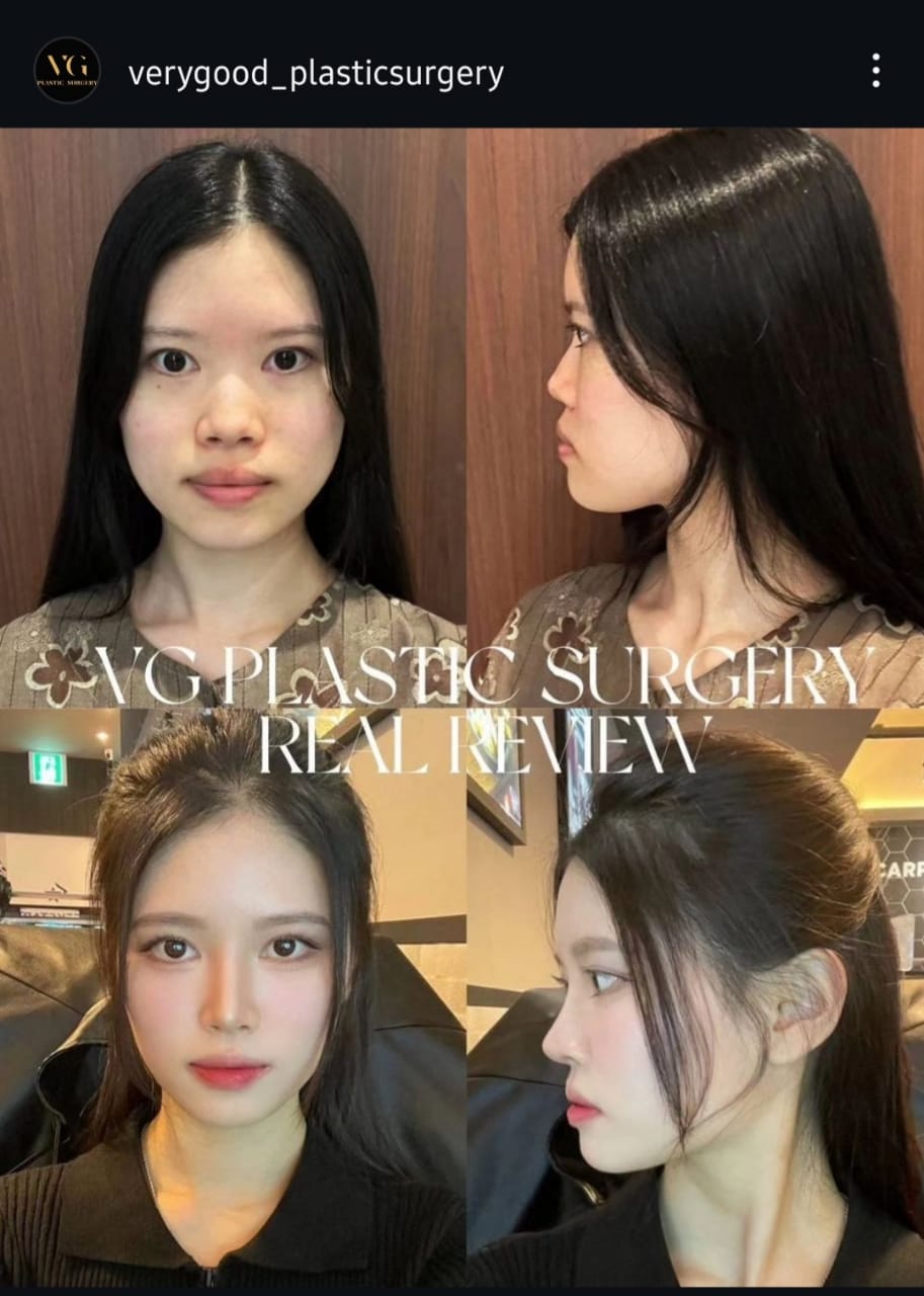 Before and after result by Dr. Im Young Min