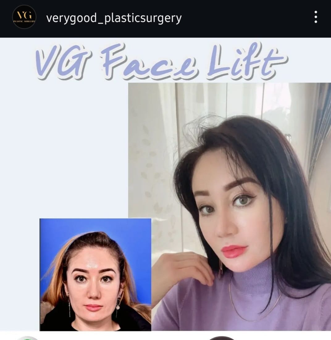 Before and after result by Dr. Im Young Min