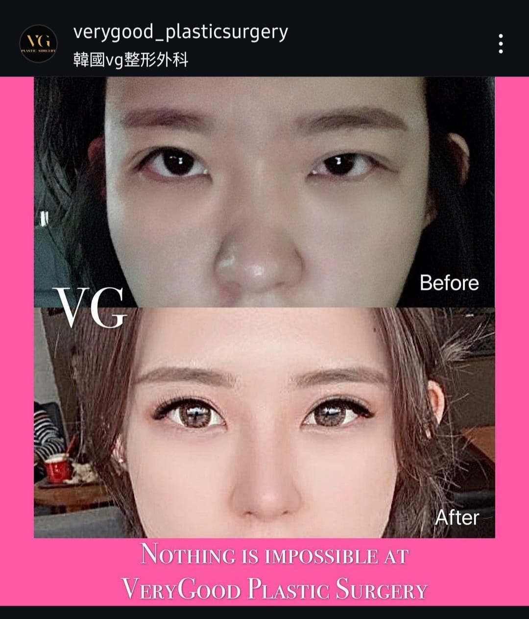 Before and after result by Dr. Im Young Min