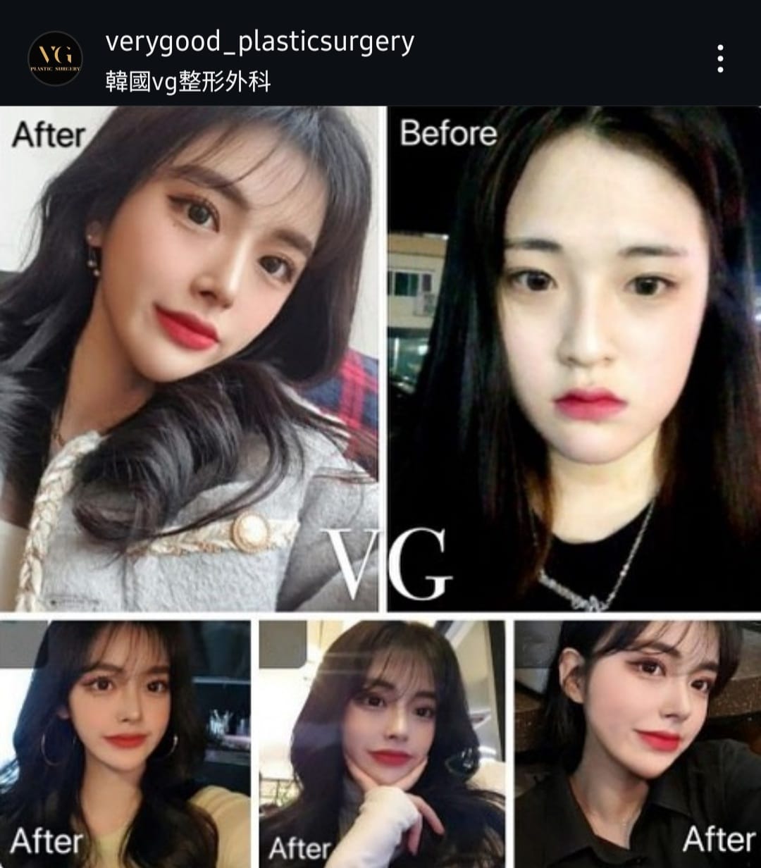 Before and after result by Dr. Im Young Min