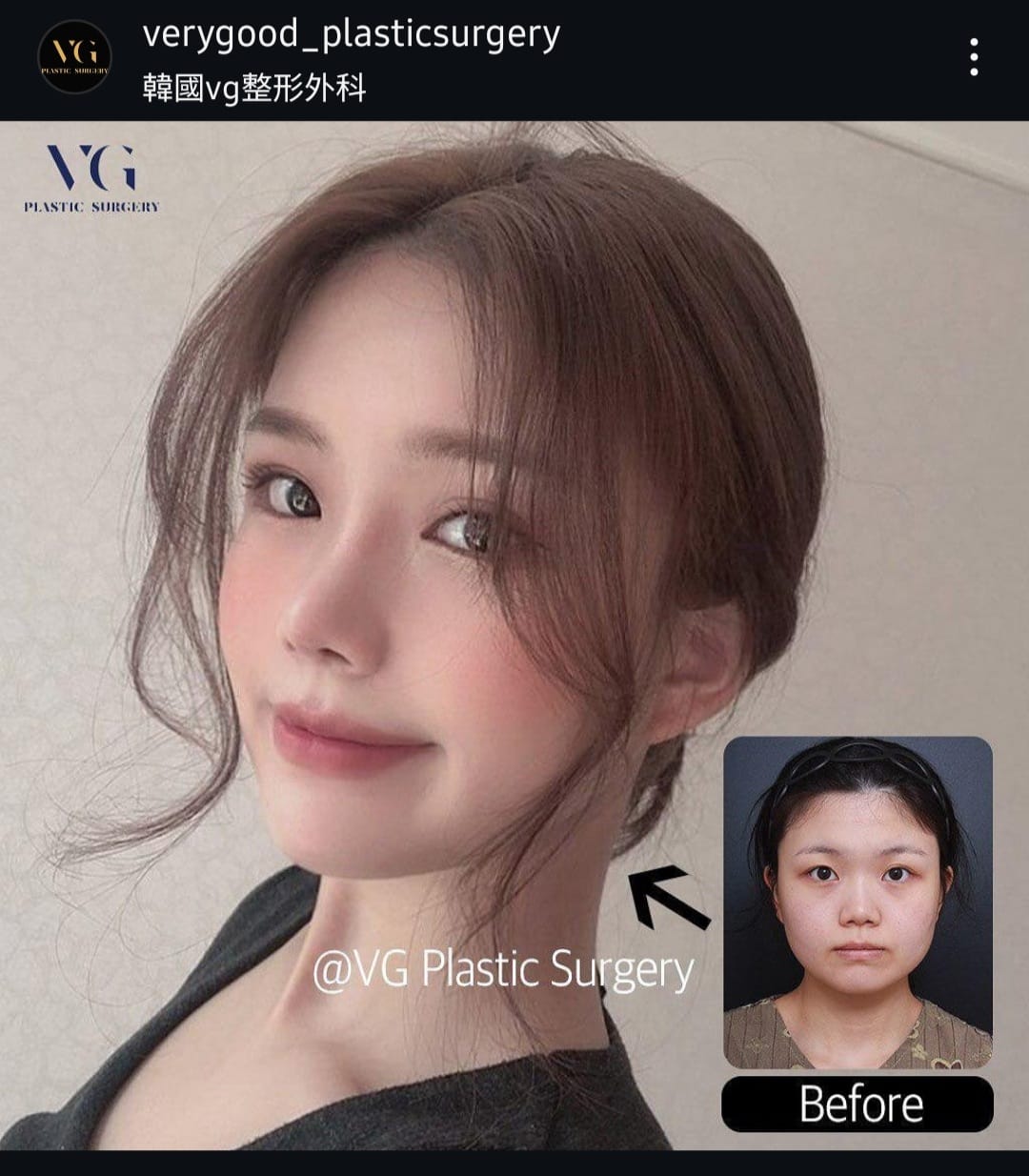 Before and after result by Dr. Im Young Min