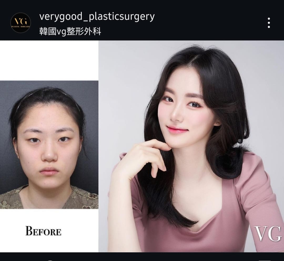 Before and after result by Dr. Im Young Min