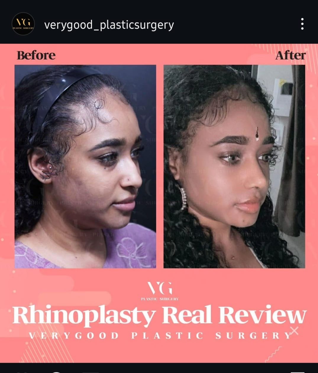 Before and after result by Dr. Im Young Min
