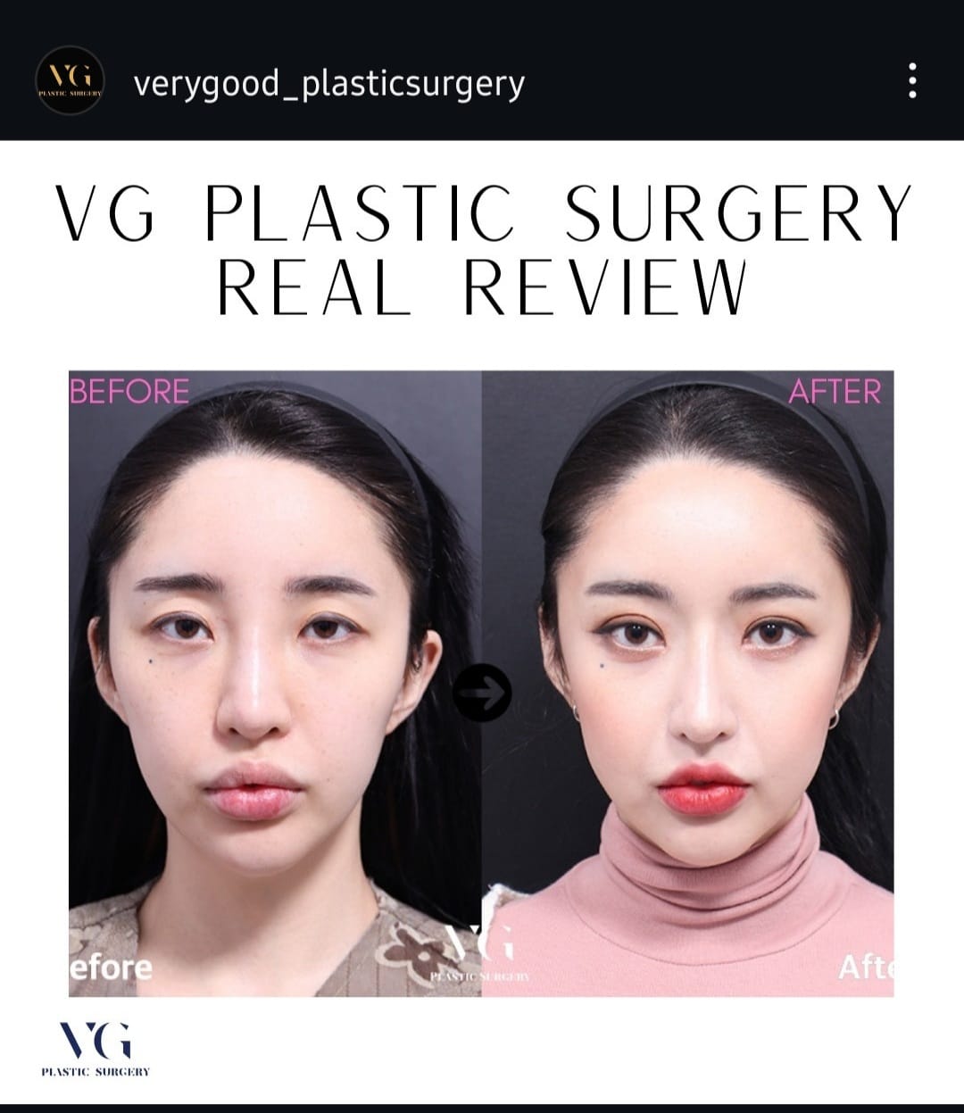 Before and after result by Dr. Im Young Min