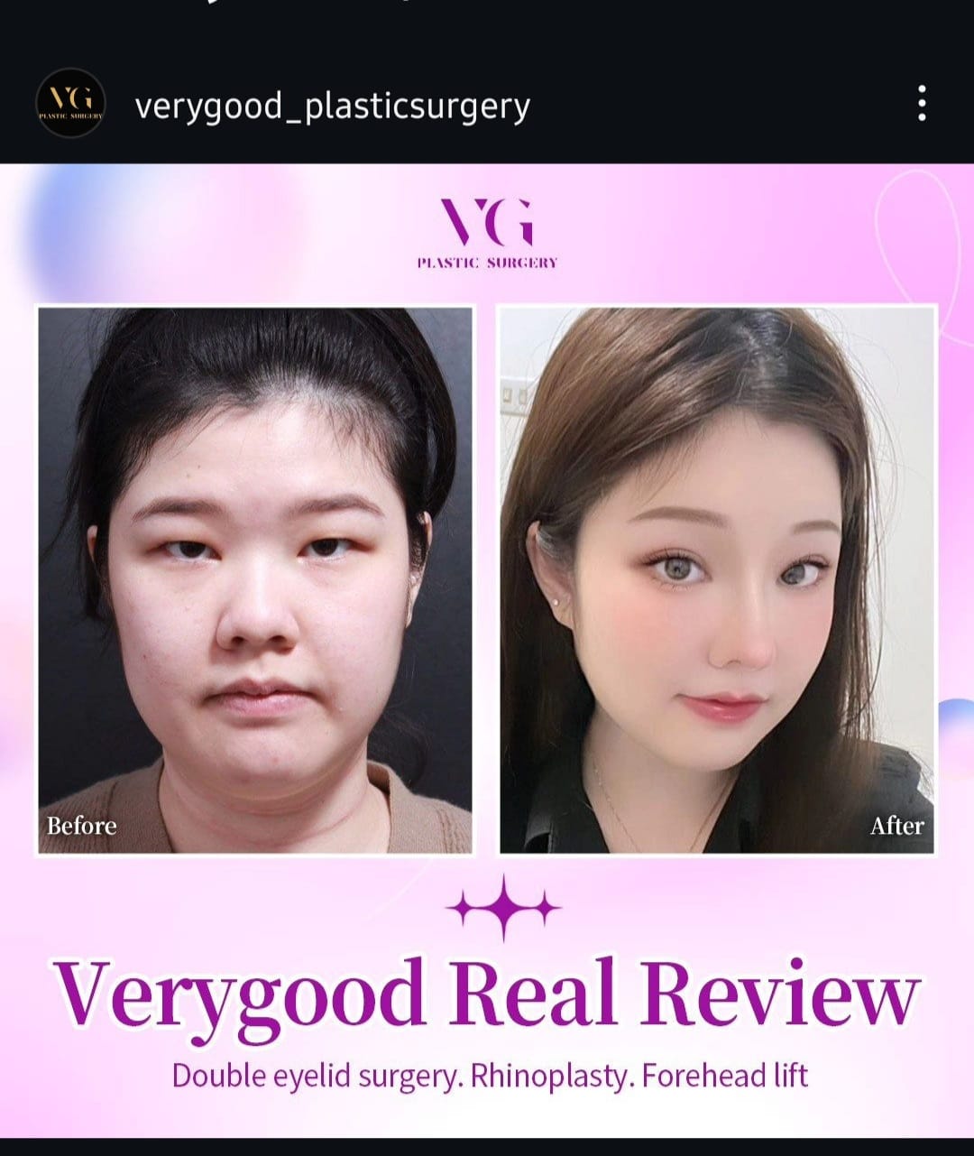 Before and after result by Dr. Im Young Min