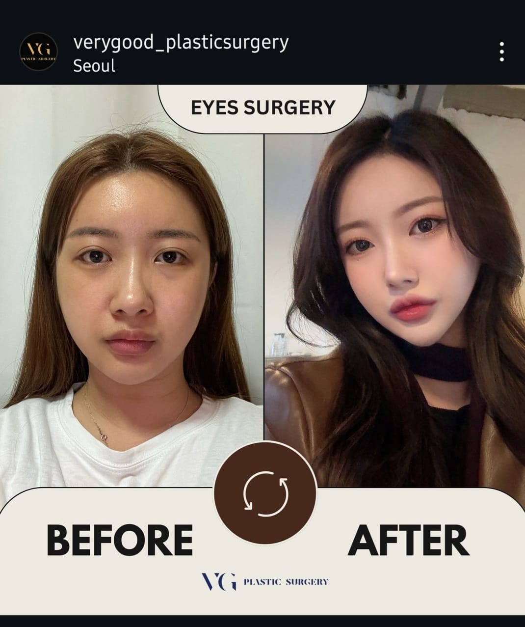 Before and after result by Dr. Im Young Min
