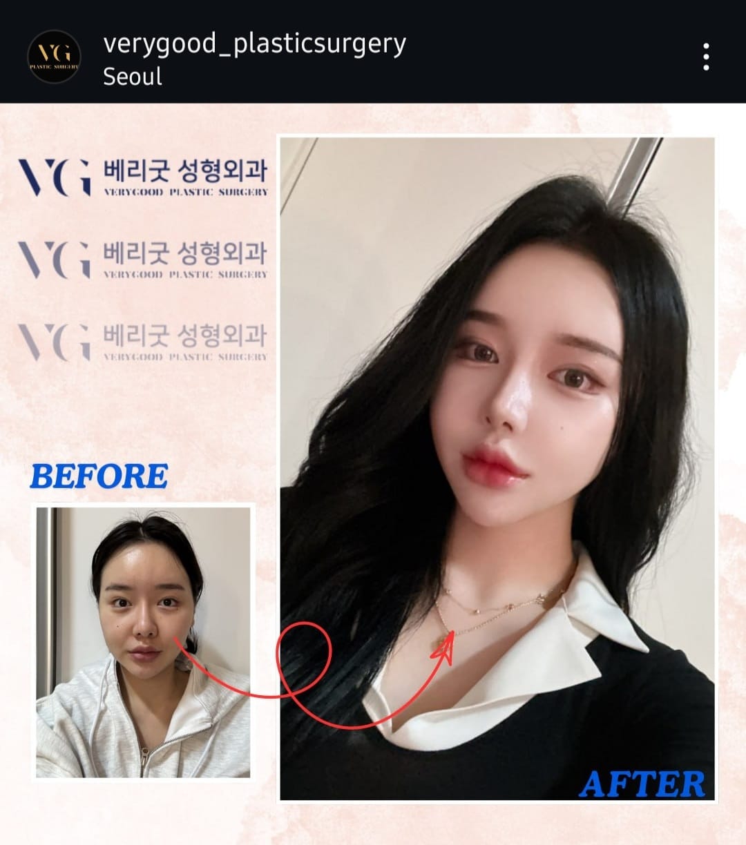 Before and after result by Dr. Im Young Min