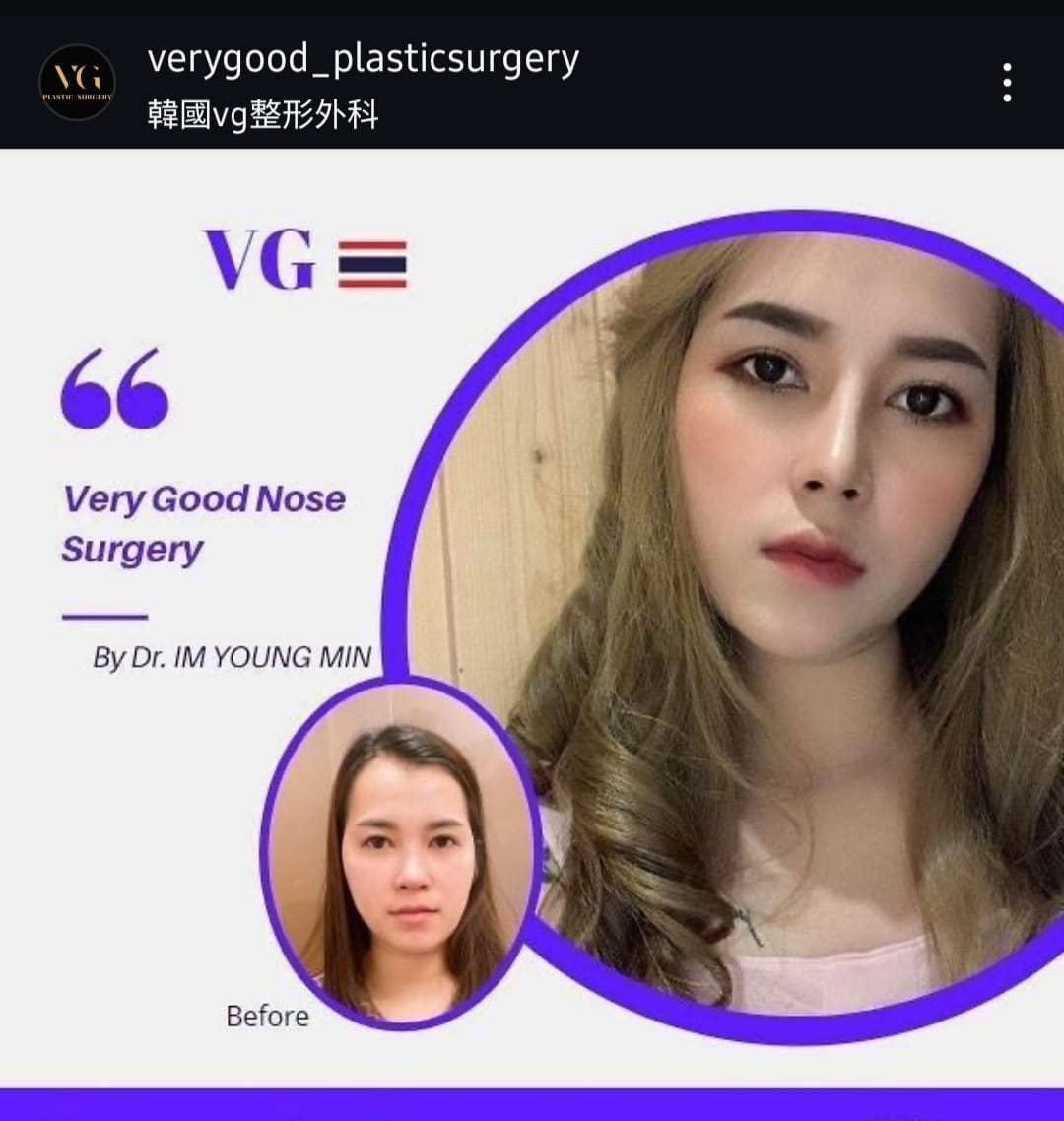 Before and after result by Dr. Im Young Min