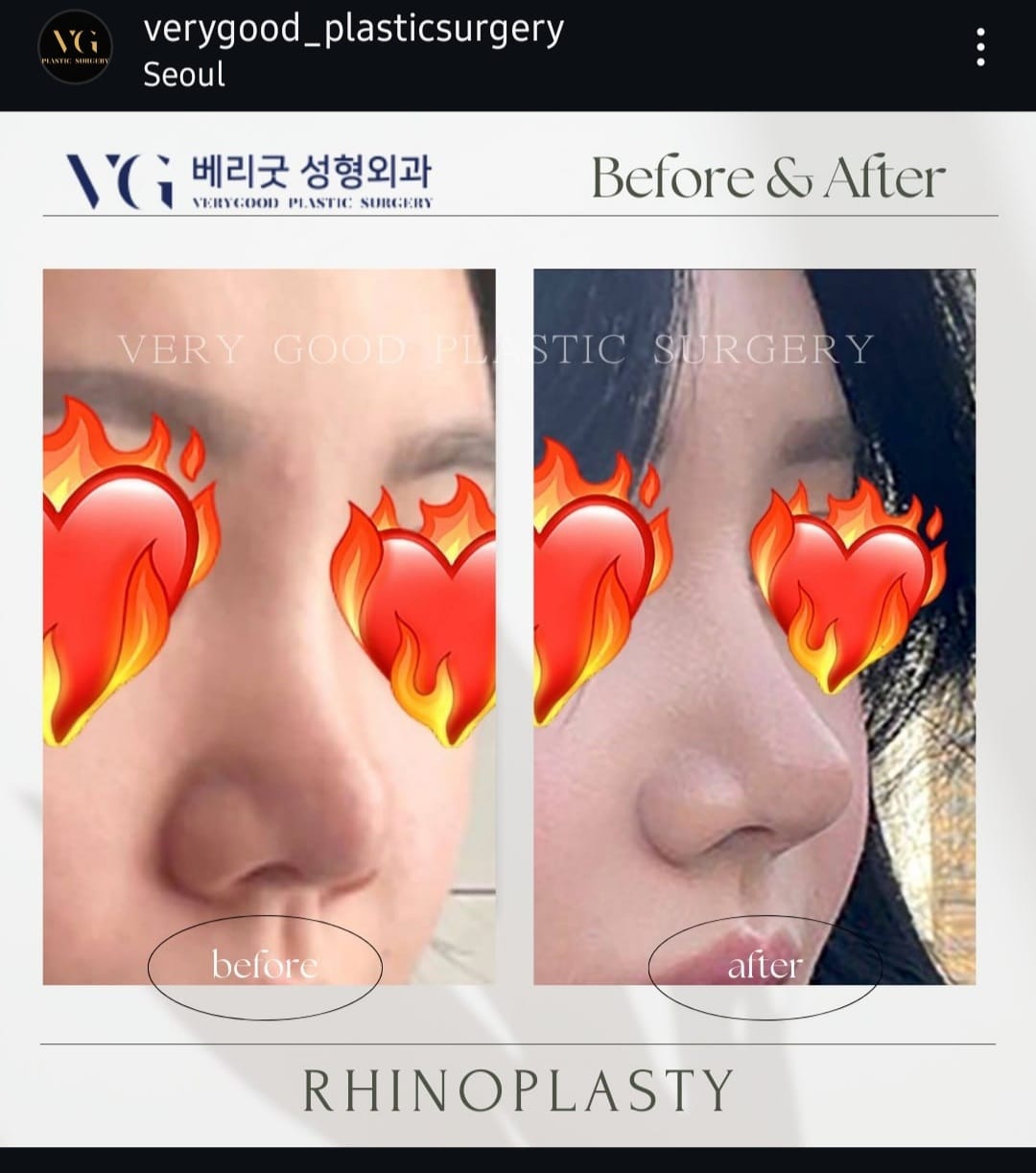 Before and after result by Dr. Im Young Min