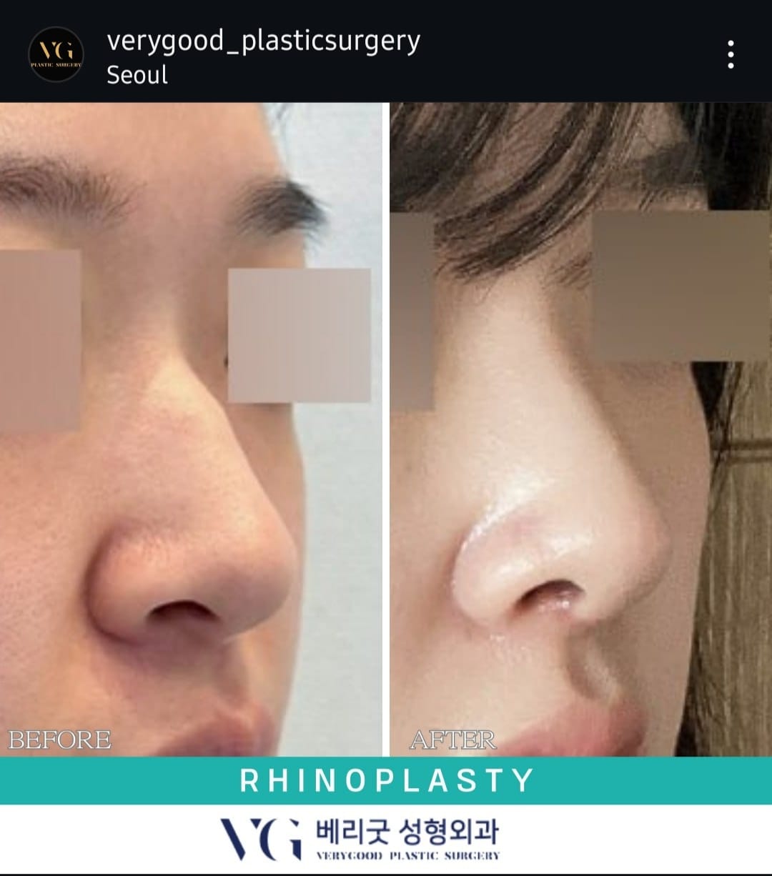 Before and after result by Dr. Im Young Min