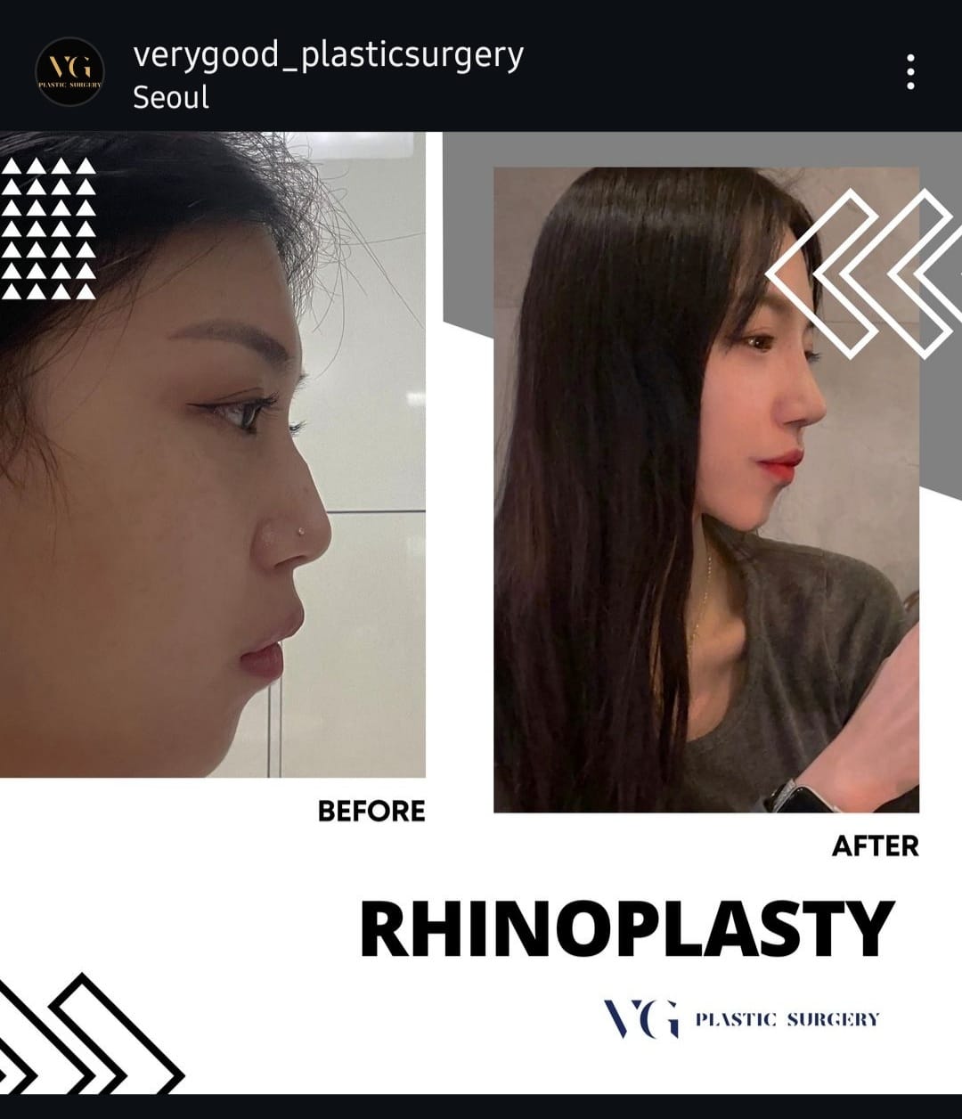 Before and after result by Dr. Im Young Min