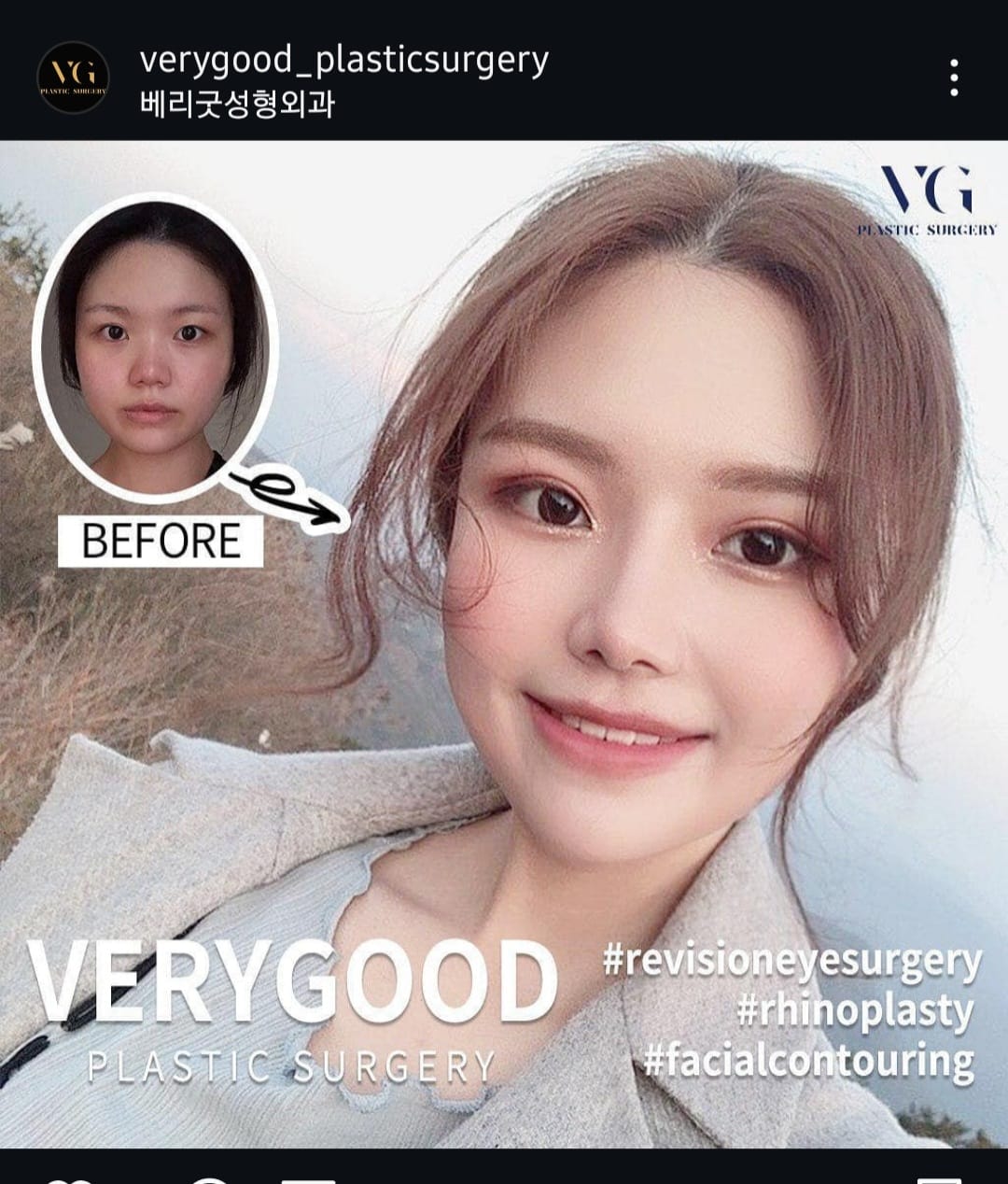 Before and after result by Dr. Im Young Min
