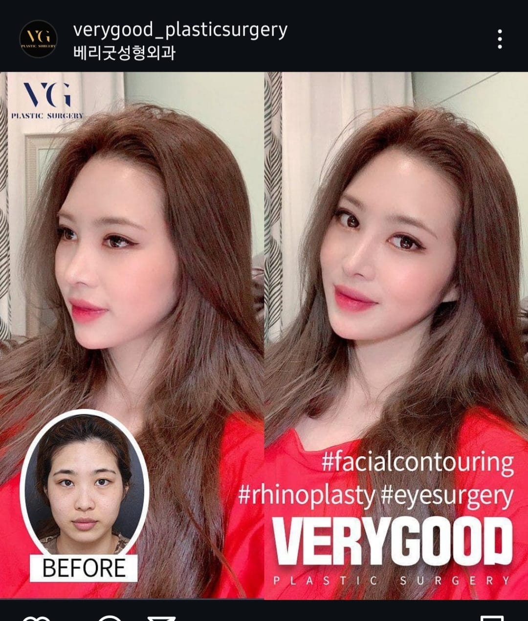 Before and after result by Dr. Im Young Min